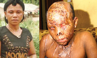 Married man ends up in jail after acid attack on lover 