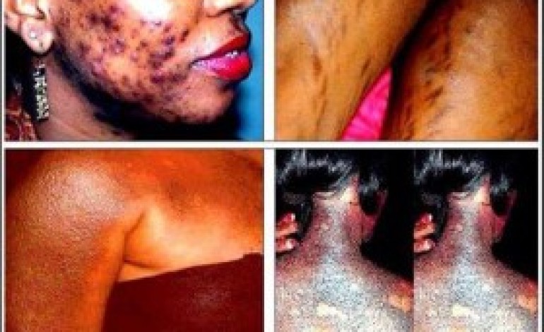 SHOCKING Pictures OF What ‘Bleaching’ Did To Some African Women