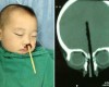 OMG! Photos: Boy has chopstick removed from brain after shoving it up his nose