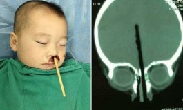 OMG! Photos: Boy has chopstick removed from brain after shoving it up his nose