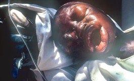 OMG! End time Close,PHOTO: Another Deadly Virus Surfaces – Marburg Haemorrhagic Fever (MHF) 