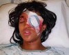 Injustice! Pregnant Mother Of Two Loses An Eye After Being Shot By St. Louis Cops With Bean Bag Round