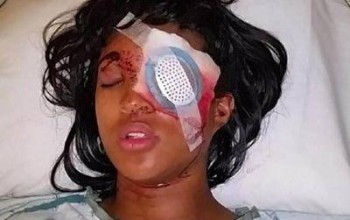 Injustice! Pregnant Mother Of Two Loses An Eye After Being Shot By St. Louis Cops With Bean Bag Round