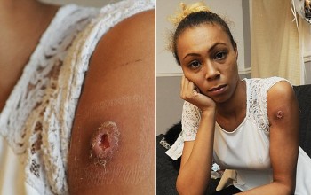 Mystery spider attack leaves woman, 21, with paralysed arm after being bitten in her sleep