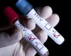 HIV’s Ability to Cause AIDS is Weakening Over Time – Scientists