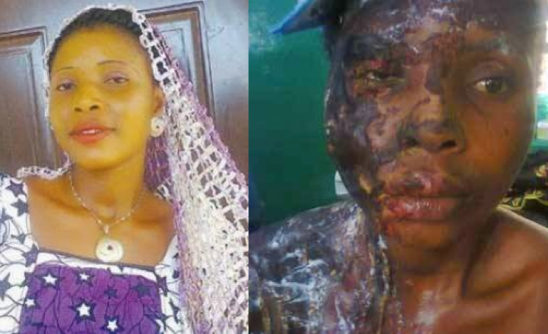 #Domestic #Violence: Man baths ex-lover with acid in Kogi state