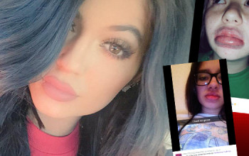 #KylieJennerChallenge leaving teens with bruised lips, face hickies going #Viral