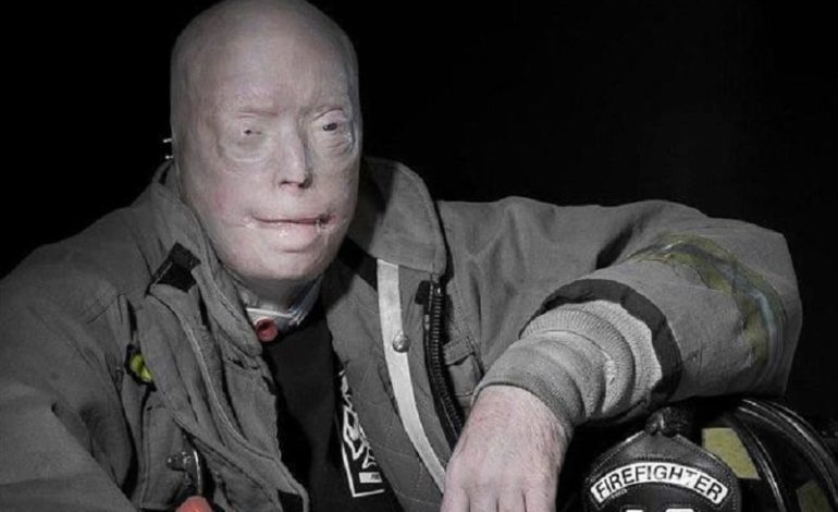 That’s how the man with no face looks like one year after full face transplant (photos)
